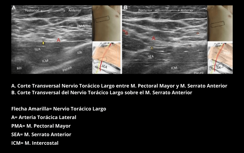 Nervio Toracico largo (1).png